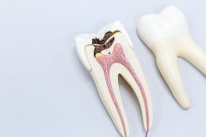 虫歯、歯髄炎