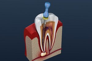 歯の神経の治療（根管治療）とは？