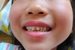子供の歯の矯正はいつから始めたらいい？